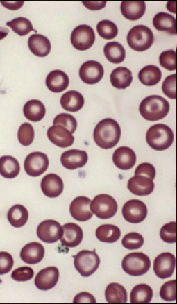 Normal red blood cells