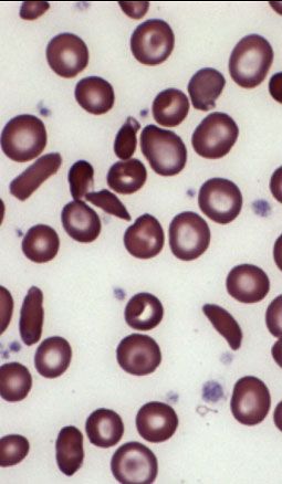 sickle cell anemia cells