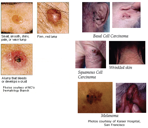 Examples of skin cancer