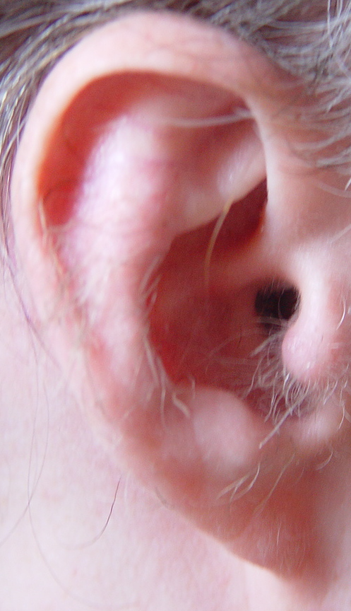 Attached earlobe